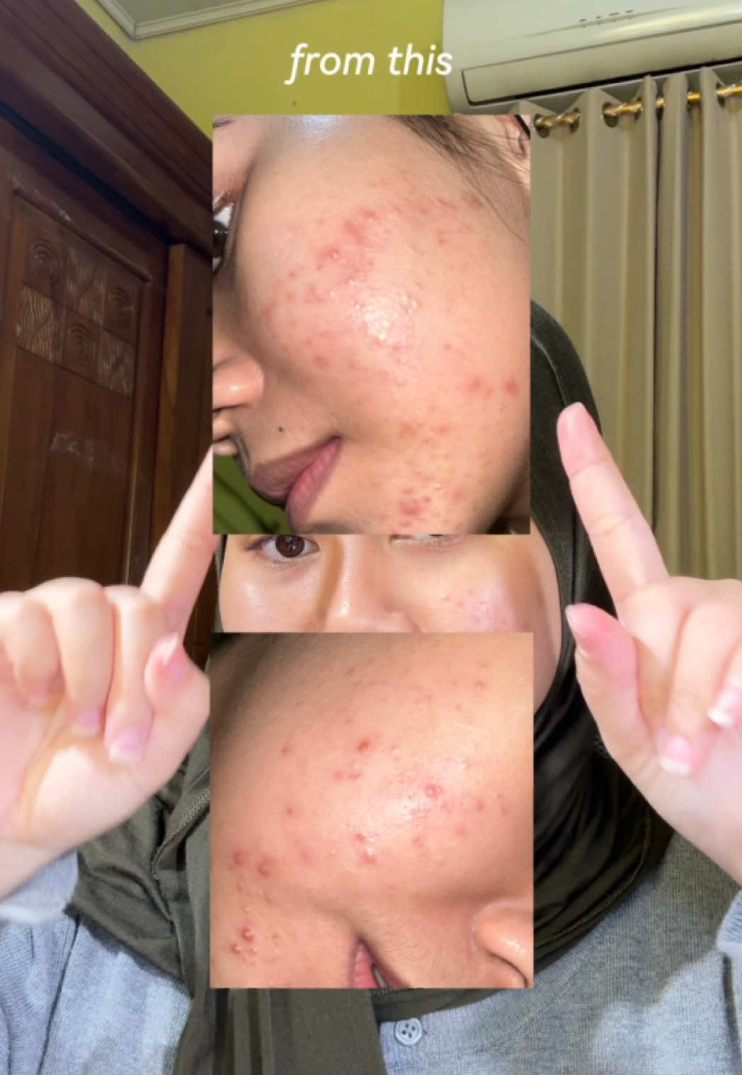 pertolongan pertama kulit klonlagi rewel versi aku @msglow.beauty #msglowbeauty #calmblemish #skincareroutine #kulitsensitif #acneskin