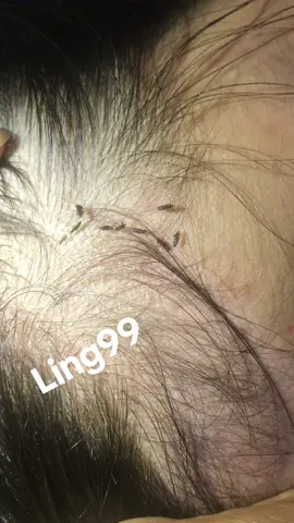 Remove lice#😭😭🥰🥰😱😱🤮🤮🥶🥶 #lice #liceremoval 