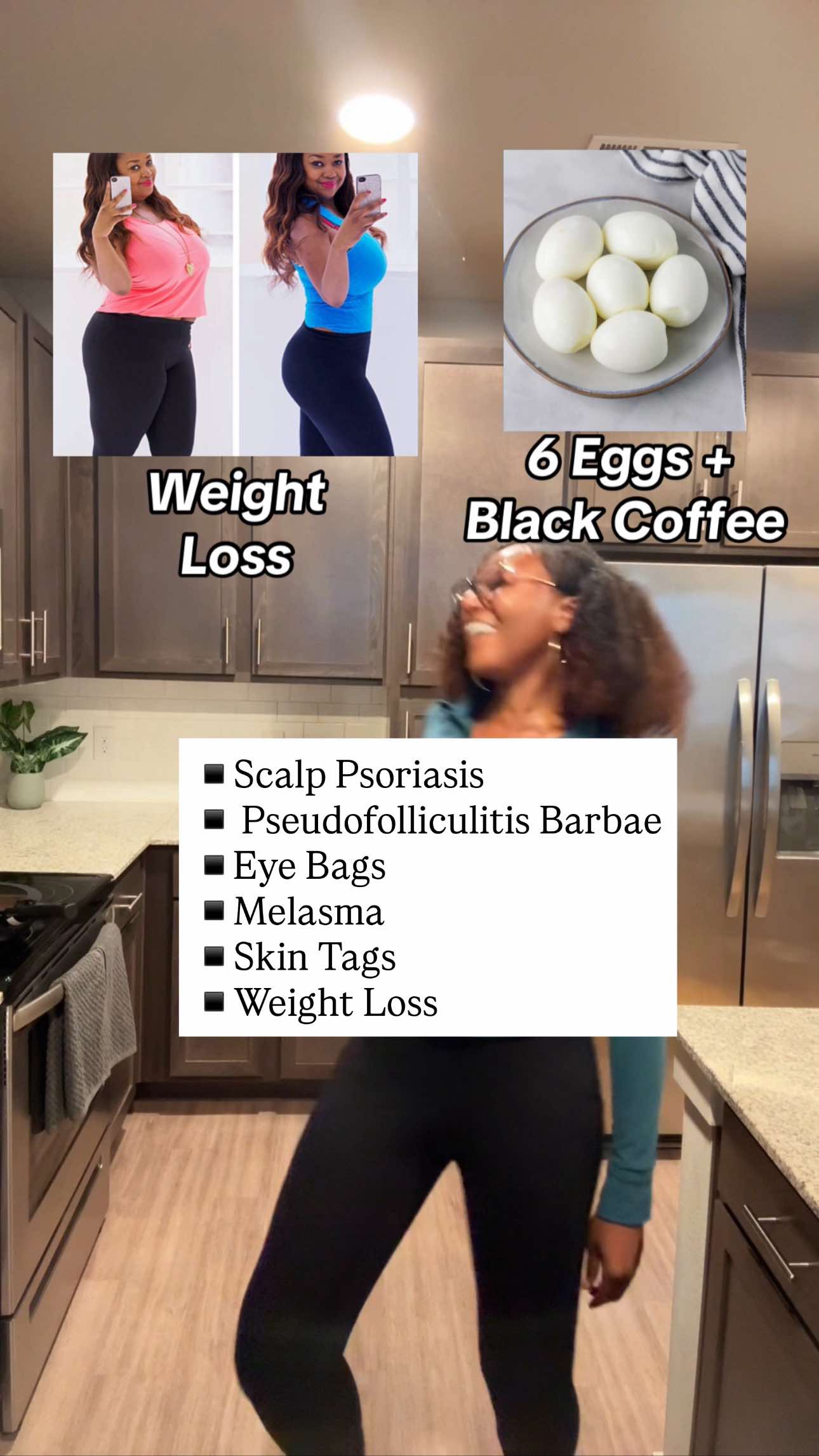 ▪️Scalp Psoriasis: Coal Tar + Salicylic Acid Shampoo or Steroid Foam + Pre-Wash Oil ▪️Pseudofolliculitis Barbae: Benzoyl Peroxide + Electric Clipper + Salicylic Acid or Laser Hair Removal  ▪️Eye Bags: Caffeine Eye Solution or Blepharoplasty  ▪️Stubborn Melasma: Oral Tranexamic Acid + Zinc Oxide SPF ▪️Skin Tag: Freeze Kits or In-Office Cryotherapy  ▪️Weight Loss: 6 eggs (satiety) + Black Coffee (appetite suppressant). - #skincaretips #hyperpigmentation