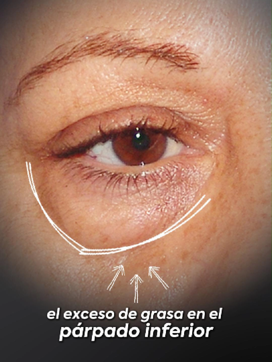 ¿Bolsas bajo los ojos? Con la blefaroplastia inferior, eliminamos o redistribuimos el exceso de grasa en el párpado inferior, suavizando el volumen y devolviendo armonía a tu mirada. ✨ Corrige bolsas ✨ Mejora el contorno del ojo ✨ Resultados naturales y duraderos 📍 En Elebelle, cada intervención se adapta a tu rostro. Agenda tu evaluación personalizada. #Tacna #peru🇵🇪 #Chile #Blefaroplastia #estetica #bellezanatural #cuidadodelapiel #Tacna #Blefaroplastia #rejuvenecimientofacial