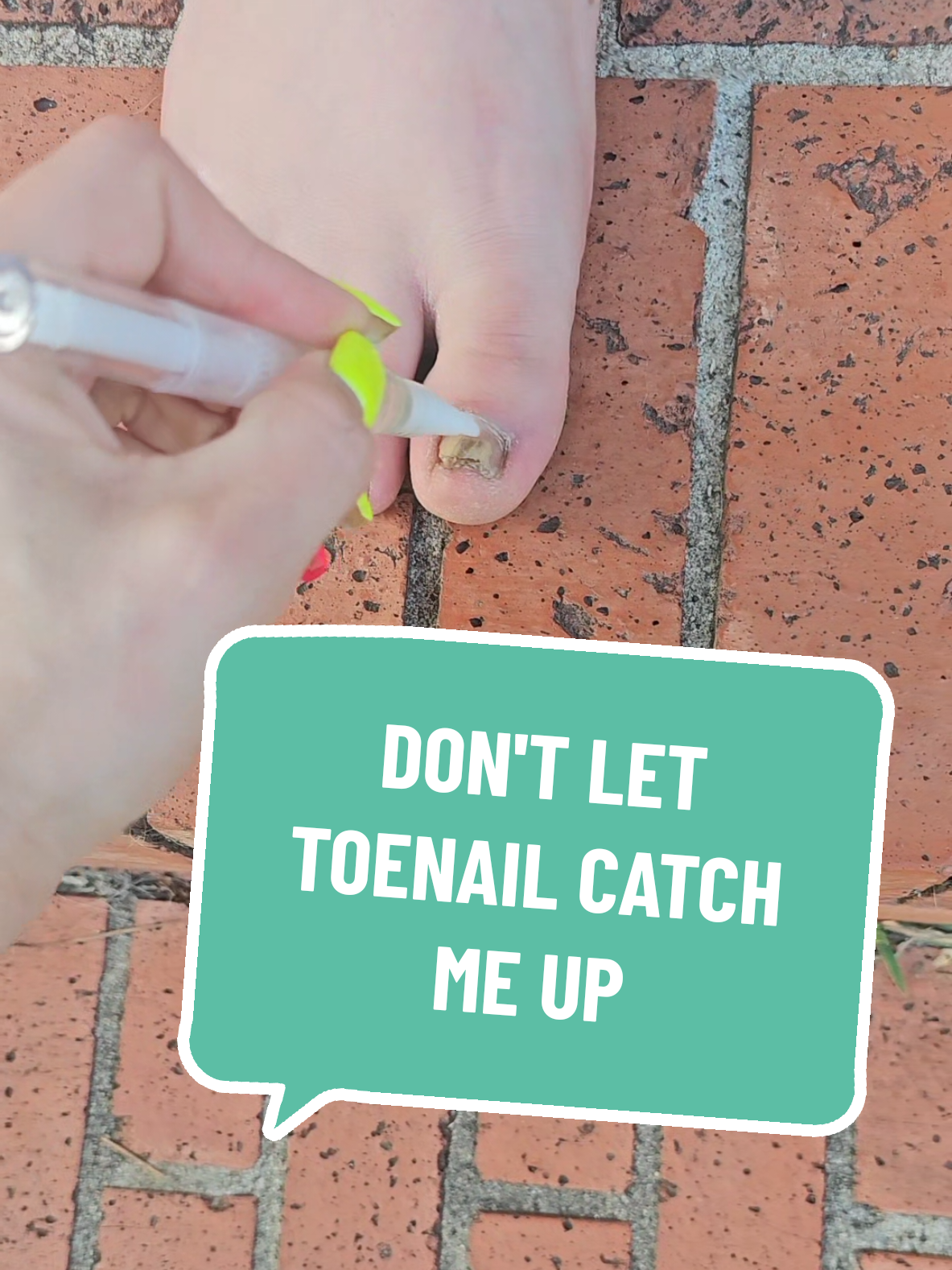 Don't let toenail Fungus catch you up #lunavia #feet #antifungal #footfungus  #toenailfungustreatment 