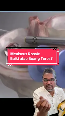 Meniscus Rosak: Baiki atau Buang Terus? Ramai pesakit datang tanya saya — kalau meniscus koyak, patut ke saya repair atau buang je terus? Dalam video ni saya terangkan beza antara meniscus repair vs meniscus removal, termasuk kelebihan dan kekurangannya. Dan jangan lupa, saya juga akan sambung dalam video seterusnya: Apa yang akan berlaku bila kita remove sebahagian meniscus tu? 📌 Nak tahu pilihan terbaik untuk lutut anda? Tonton video ni dulu. Kalau ada apa2 soalan tentang pembedahan lutut atau pinggul, boleh PM saya. WhatsApp untuk buat appointment 👉🏼 www.wasap.my/60164201585/HelloDrJR #DrJR #MeniscusTear #PembedahanLutut #OrthopaedicSurgeon #LututSakit #MeniscusRepair #MeniscusRemoval #SendiSihat #TipsKesihatan #SunwayMedicalCentre