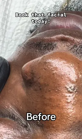 #fyp #trending #viralvideo #blackheads #extractionslovers 