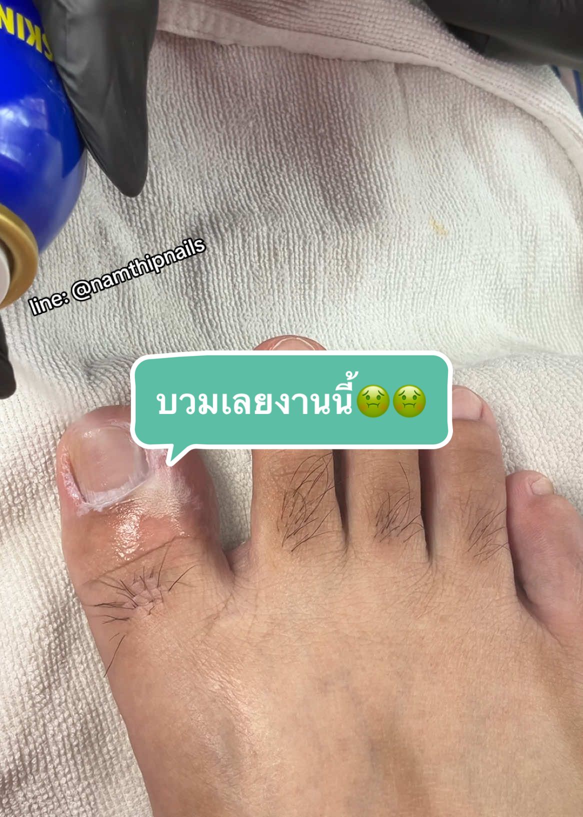 💓 #namthipnails #ตัดเล็บขบ #ตัดหนัง #ทำเล็บ #ร้านตัดเล็บขบ #ร้านตัดเล็บขบราม2 #ตัดเล็บ #เล็บขบ  #เล็บเชื้อรา Fb : namthipnails  Line : @namthipnails  นัมเบอร์วัน8 ตลาดม.ราม2  กทม  Map: namthipnails  https://goo.gl/maps/JmwpCKLfKwmhKGK96  ร้านเปิดทุกวัน เวลา12.00น-22.00น.