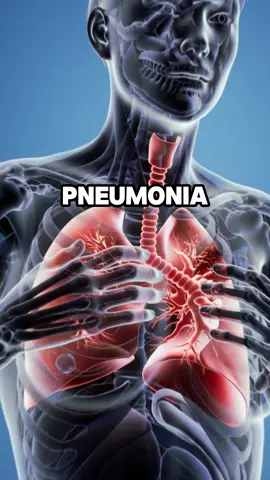 What is pneumonia? What are its signs? #healthy #healthtips #healthtip #nutrition #lung #lungs #pneumonia 