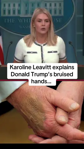 Donald Trump has been diagnosed with chronic venous insufficiency, as per Karoline Leavitt #trump #presidenttrump #karolineleavitt #leavitt 