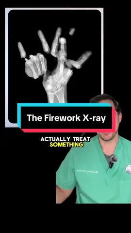 Comment NEWSLETTER and I'll send you a link to my free weekly newsletter with more helpful health information 🗞️ 👉 As for the video, always try to save the thumb 👍 !  It's like the captain of the ship when it comes to your hand. 🧨 Fortunately, I did not see any injuries like this during the most recent Fourth of July celebration, but that is one of the days when these severe firework injuries most often occur. 🚨 Never hold a lit firework because you never know when it might go off unexpectedly. 😷 As for the surgery itself, something like that X-ray shown in the video could take anywhere from 5 to 15 hours depending on how many digits you were trying to reattach.  In the case the long, ring, and small finger, there's a segmental injury, which would make them extremely difficult to salvage.  👉 My fellow healthcare providers, let me know in the comments what are some of the most intense injuries you've treated in your career and what you've learned from them.  I know most hand surgeons don't play around with fireworks, and I'm sure neurosurgeons don't go car surfing.  #firework #hand #xray #safety 