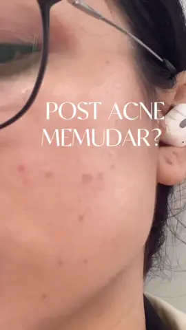real after pemakain 2 bulan, post acne memudar 🤍 #hanasui #serumgakharusmahal #fyp 