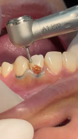 Anterior composite veneer for deep tooth cavity in lateral incisor  #dentist #dental #dentistry #teeth 