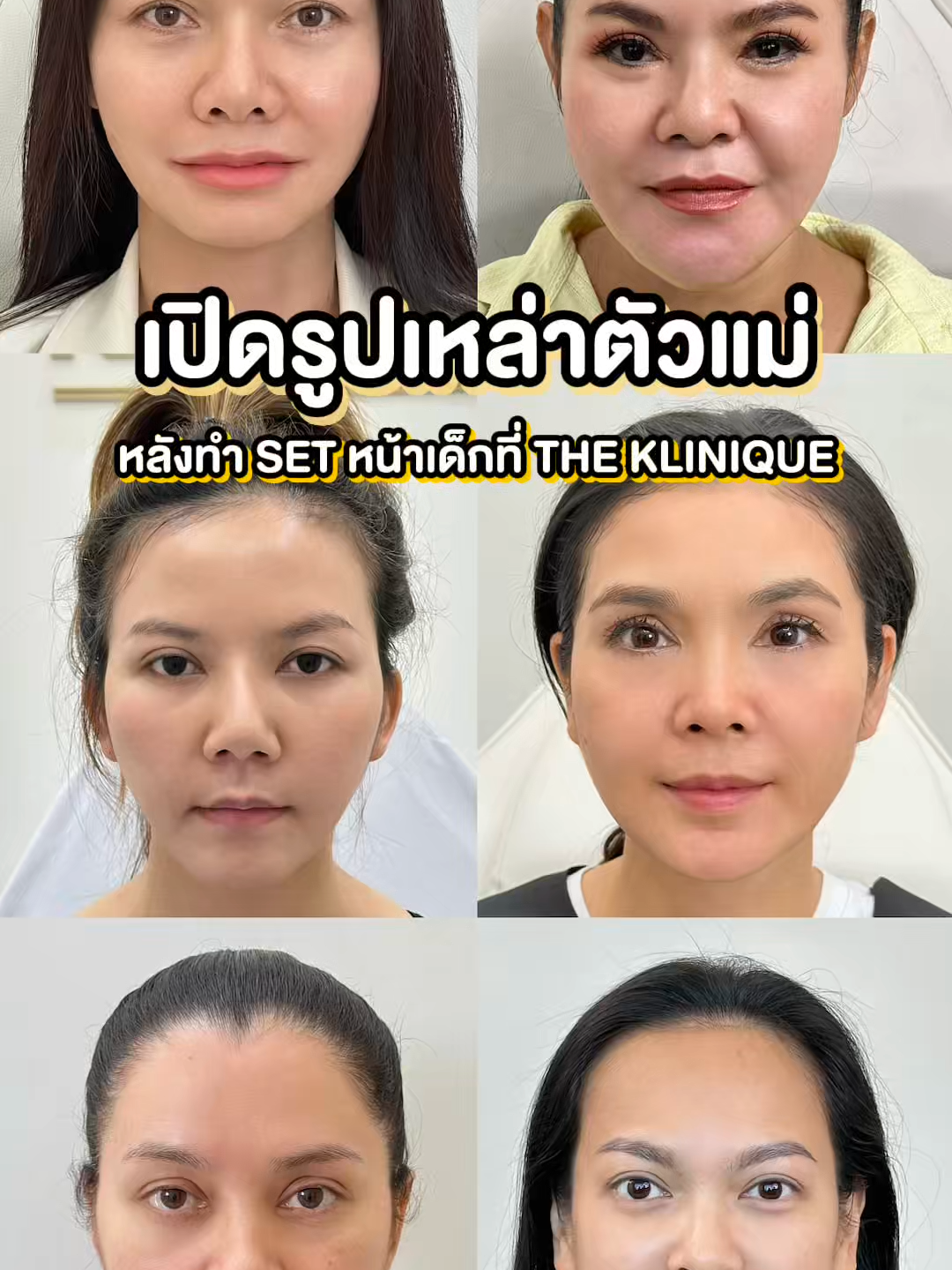 ตัวแม่วงการลูกทุ่ง เลือกโปรแกรมหน้าเด็กที่ THE KLINIQUE เท่านั้น #THEKLINIQUE #เดอะคลีนิกค์ #ต่ายอรทัย #ฮายอาภาพร #จ๊ะนงผณี #ฝนธนสุนธร #แมงปอชลธิชา #พาเมล่าเบาว์เด้นท์