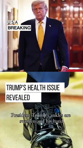 #presidenttrump #bruisemakeup #trumphealth White House explains President Trump’s swollen ankles and bruised hands. The White House says he has chronic venous insufficiency. What does that mean? #trending #fypシ #foryoupage #viralvideo #life #news #greenscreen 