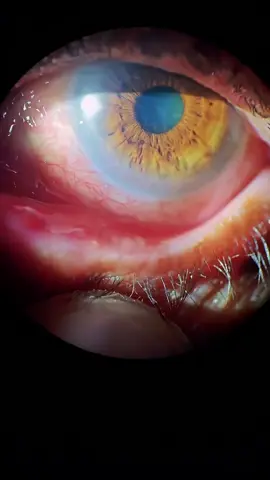 👁️ Clinical Case Review | Herpetic Keratouveitis Patient: 65 y.o. C/O: Eye pain & redness V/A: Counting fingers (CF) IOP: 23 mmHg 📝 Initial Management (2 weeks ago): – Antiviral therapy – Lubricating drops – Mild topical steroid (Loteprednol) 🔄 Follow-up Findings: Persistent inflammation with elevated IOP and low vision prompted treatment intensification. 💊 Updated Treatment Plan: – Topical Prednisolone 6×/day – Homatropine 3×/day (cycloplegic) – CMC 1% (lubricant) 6×/day – Omnacortil 30 mg/day (oral steroid) – Trymox (Acetazolamide) BID (to manage IOP) ⸻ 🧠 Diagnosis Suggestion: Likely Herpetic keratouveitis — a challenging case with anterior uveitis and secondary elevated IOP. #retina #oftalmo #ophthalmology #oftalmologia #oftalmología #ophtalmologie #офтальмологія                   