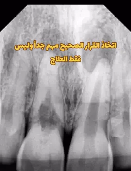 اختر طبيبك وناقش معه الخيارات #الم #اسنان #علاجات_طبيعيه #علاج_عصب #طبيب_اسنان #افضل_طبيب_اسنان #الاسنان #الخبر #السعودية #الدمام_الخبر_الاحساء_الجبيل_الظهران #الشرقية #عيادات_اسنان #افضل_طبيب_اسنان  #الم_العصب #الصينين_مالهم_حل😂😂  