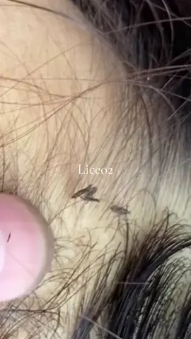 😱😱#omg #lice #liceremoval 