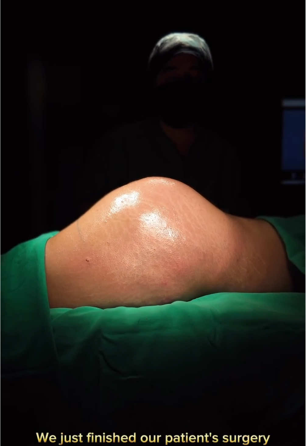 560 CC Butt Implant 🌟🌸