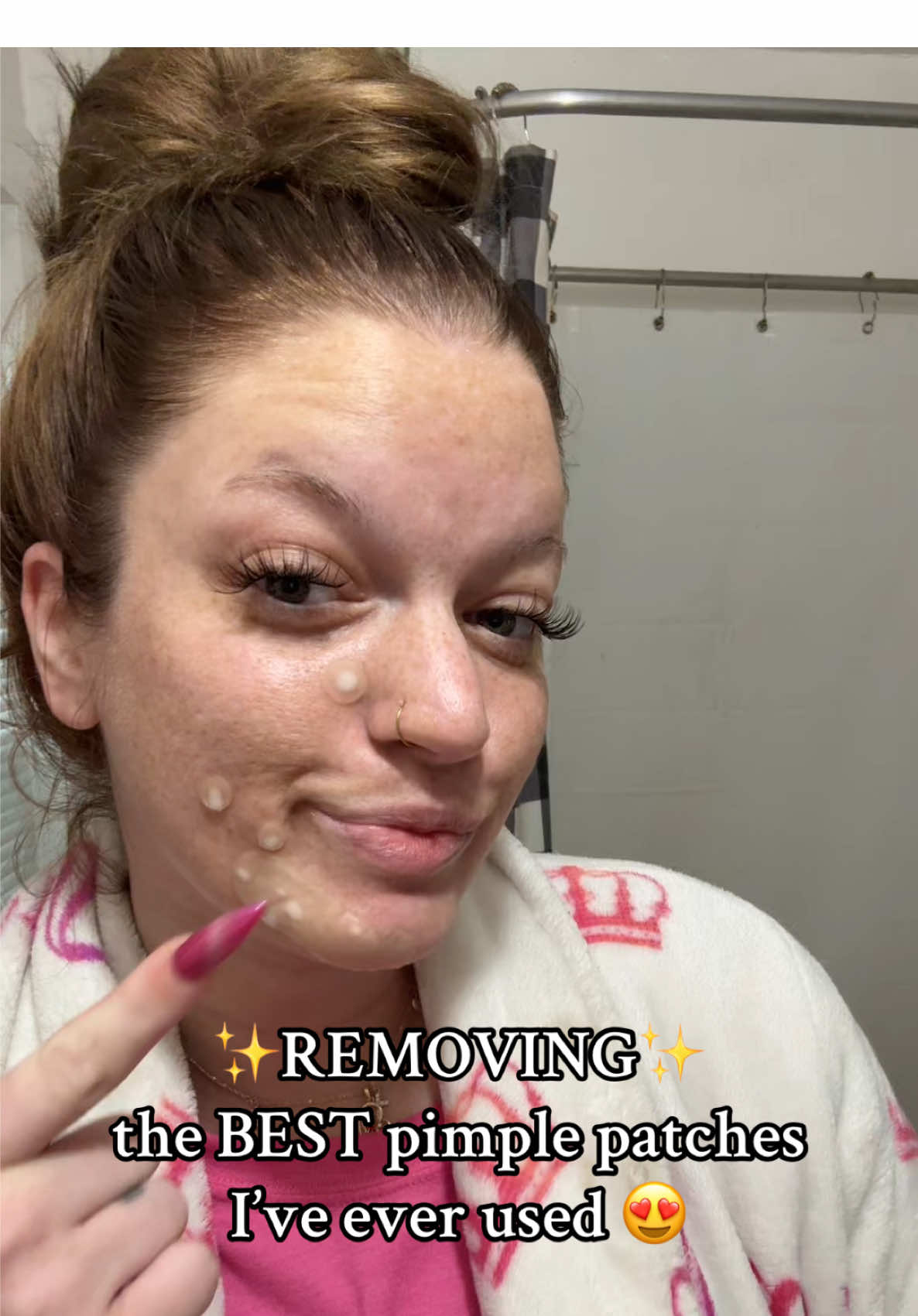 Pimple patch pull 😍😍 IM BLOWN AWAY @Livaclean #pimplepopping #pimple #skincare #skincareroutine #pimplepopper 