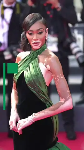 Winnie Harlow : Personne ne voulait d’elle jusqu’à ce qu’un basketteur célèbre change sa vie. #winnieharlow #kylekuzma 