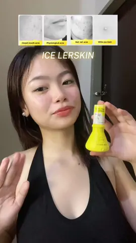 Life saver!! 💛 #beatizza #antiacneessence #skincare #acne #acnekiller