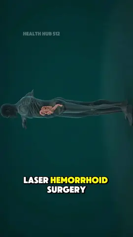 Laser Hemorrhoids Treatment Procedure                          (Medical Animation 3D) #hemorrhoids #hemorrhoidsurgery #hemorrhoidscheck #hemorrhoidsremoval #hemorrhoidswarrior #lasertreatments #3dmedicalanimation #medical3danimation #lasertherapy #laserhemorrhoidoplasty #medicalanimation 