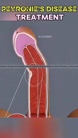 Shockwave Therapy for Peyronie's Disease (3D Animation)  #peyroniesdisease #peyronie #peyronies #peyroniestreatment #shockwavetherapy  #medical3danimation #3dmedicalanimation