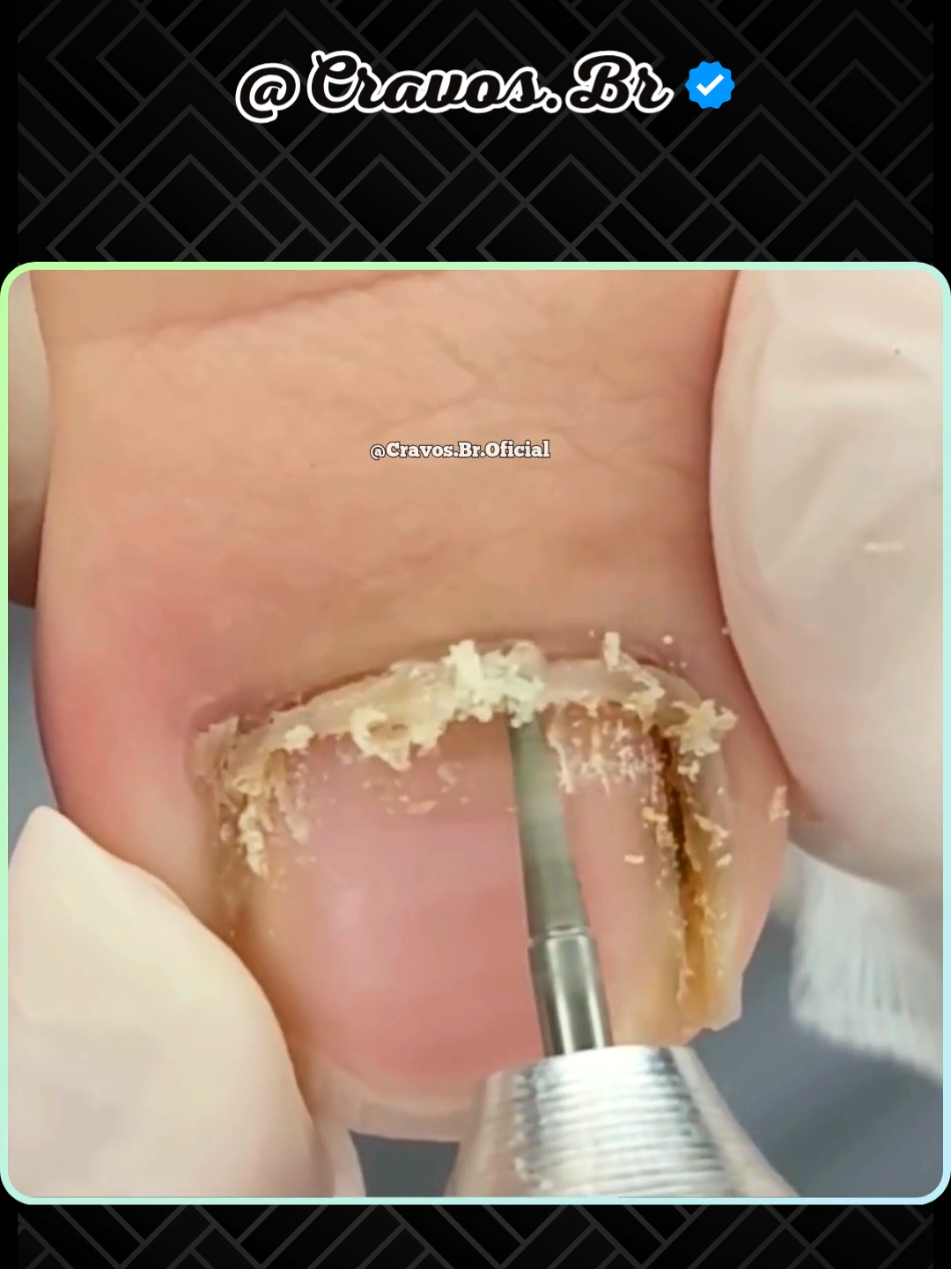 Tratamento 1278 - #unhas #pedicure #podologia #tratamento 