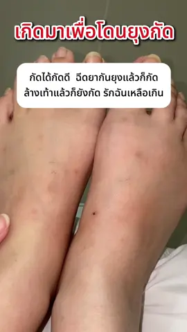 ลูกรักยุงกัดมารวมตัวกันตรงนี้ค่ะ สิ่งนี้ช่วยปกป้องคุณได้‼️🦟 #ยุงกัด #ยุงลายตัวร้าย #ยุงเยอะมากๆๆ🦟🦟 #ยุง #ยากันยุง #สเปรย์กันยุง 