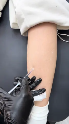 Tiêm thon gọn bắp chân to thô tiêm phát xong thon gọn lấy lại tự tin mặc váy ngắn khoe chân thon nhe 💉