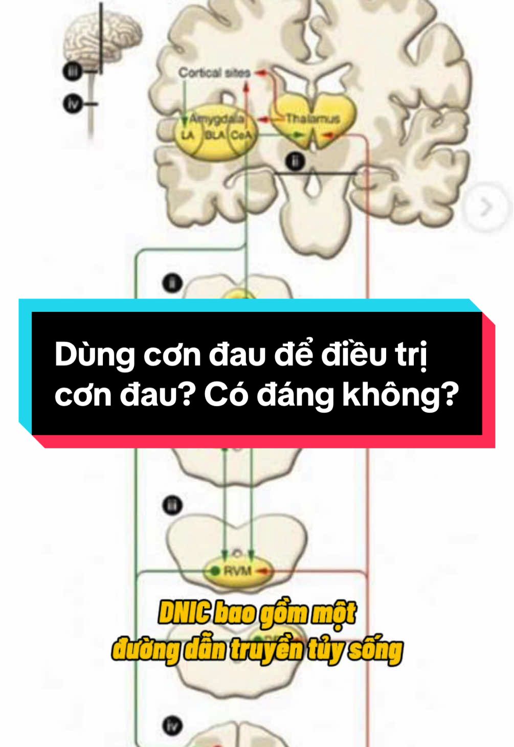 Dùng cơn đau để điều trị cơn đau? Có đáng không?