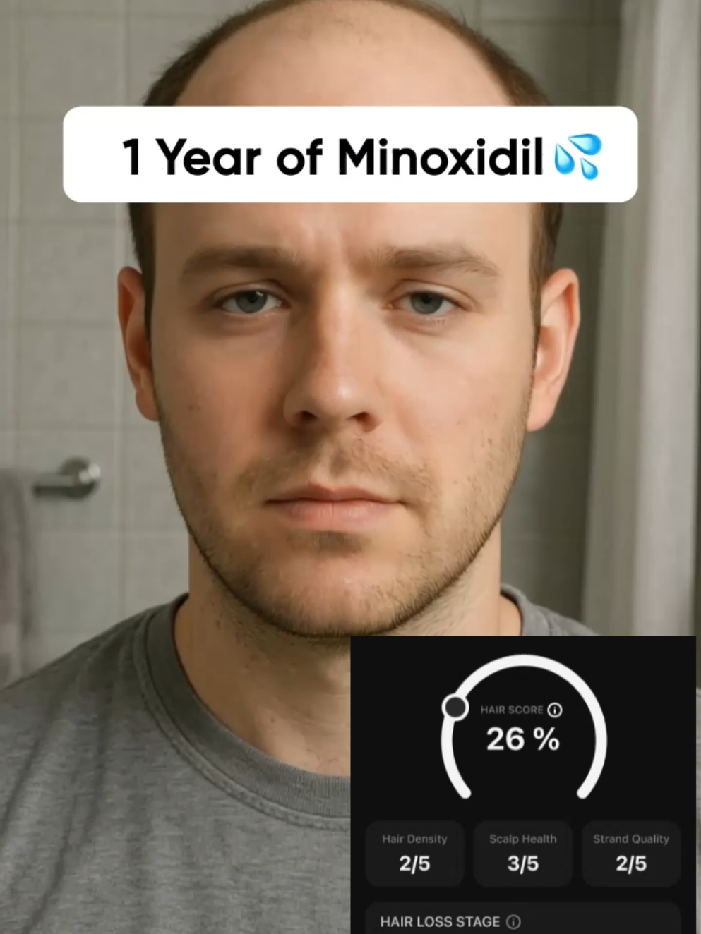 HairCode AI results are the best!  #minoxidilresult #haircodeai #hairlosstips #hairregrowth #hairtok 