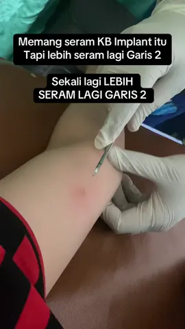 Bagi pengalaman yg udah duluan pake kb implant dong