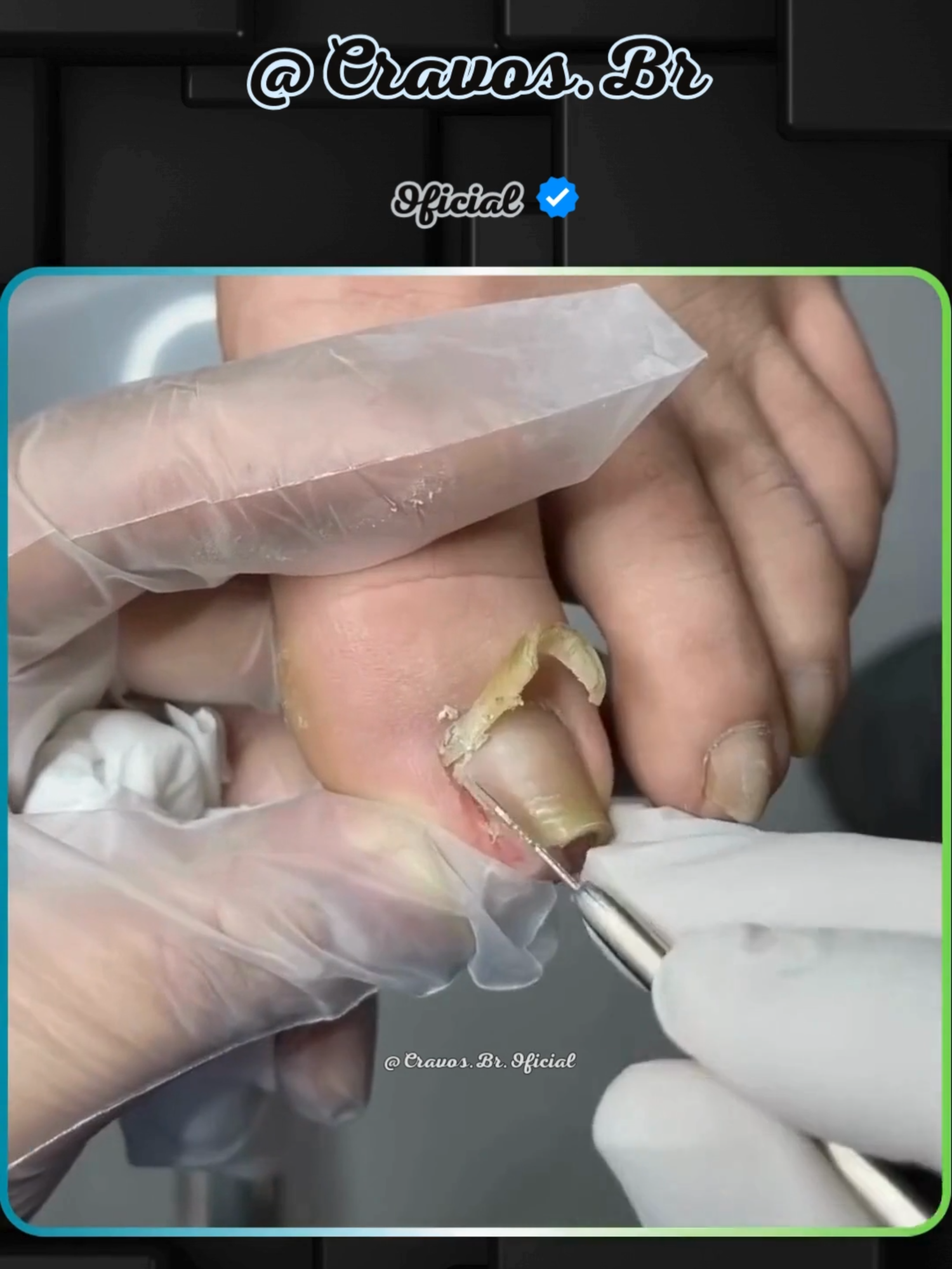 Tratamento 1280 - #Unhas #Pedicure #Podologia #Tratamento