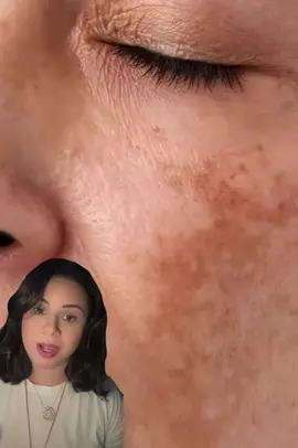 O Envy Skin Sérum Tranexâmico age direto na raiz das manchas, melasma, acne e hiperpigmentação. 💧 Fórmula com 4 ativos de alta performance: Ácido Tranexâmico, Ácido Glicólico, Alpha-Arbutin e Niacinamida. 🕑 Como usar: 	1.	Aplique à noite, com a pele limpa e seca. 	2.	Use de 2 a 3 gotas no rosto ou onde tem manchas. 	3.	Espalhe com os dedos até absorver. 	4.	Pela manhã, use protetor solar FPS 50+. ⚠️ Resultados visíveis em 2 a 4 semanas. #envyskin #serumclareador #melasma #skincarebrasil #antesedepois #manchasnapele