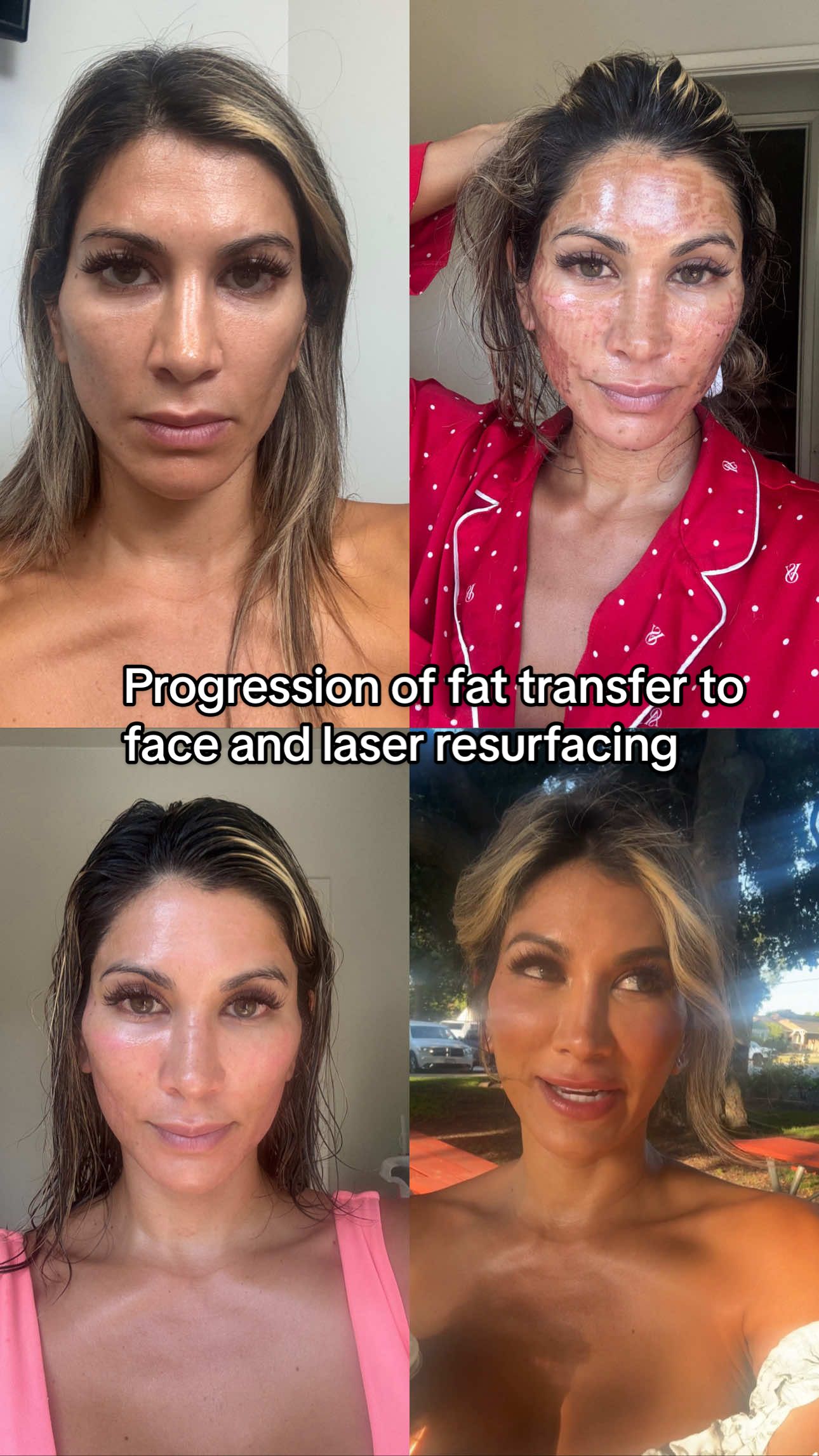One week of progression from my fat transfer to face and erbium yag laser skin resurfacing with @OrangeCountyFacialPlastics ❤️ #fyp #fattransfer #erbiumlaser #40s #skincare 