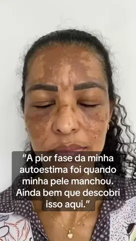 O que a maquiagem esconde, esse sérum apaga. O Envy Skin Sérum Tranexâmico age direto na raiz das manchas, melasma, acne e hiperpigmentação. 💧 Fórmula com 4 ativos de alta performance: Ácido Tranexâmico, Ácido Glicólico, Alpha-Arbutin e Niacinamida. 🕑 Como usar: 	1.	Aplique à noite, com a pele limpa e seca. 	2.	Use de 2 a 3 gotas no rosto ou onde tem manchas. 	3.	Espalhe com os dedos até absorver. 	4.	Pela manhã, use protetor solar FPS 50+. ⚠️ Resultados visíveis em 2 a 4 semanas. #envyskin #serumclareador #melasma #skincarebrasil #antesedepois #manchasnapele