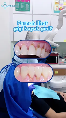 Abrasi terjadi karena kebiasaan menyikat gigi terlalu keras, atau pakai sikat dengan bulu yang kasar 😬 Akibatnya? Lapisan gigi bisa terkikis dan bikin gigi jadi ngilu terus! 💡Tenang aja, kondisi ini bisa diatasi kok! Yuk periksa dan konsultasi di Medico, biar ngilunya nggak berlarut-larut! #medico #klinikmedico #klinikkesehatan #klinikumum #klinikumumsemarang   