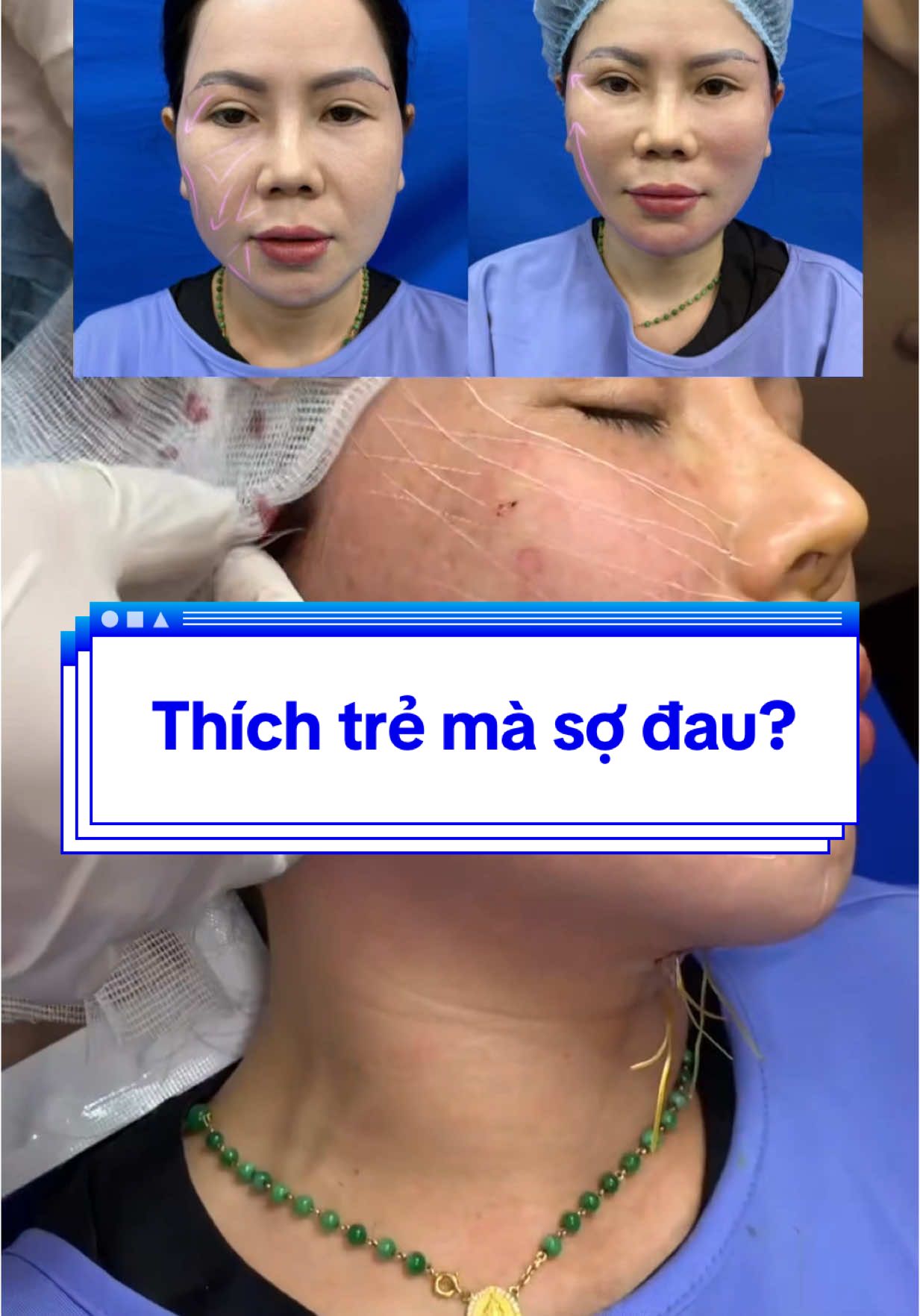 Tuổi thì lên, da thì xuống… Đừng để sợ hãi giữ chị lại mãi. Kéo nhẹ thôi là thấy mình thanh xuân trở lại #CangChiTuNhien #trehoalanda #nangco #caychi #định_hình_viền_hàm #Thắt_Nọng_Cằm #CangChiTuNhien #chiasexuhuong #nâng_cơ_táo #đàotạocăngchỉ #vivaline #ha_collagen_khử_thâm_làm_đầy_hốc_mắt #nângtầngmặtgiữa #PCL #lamdep #TreHoaKhuonMat 