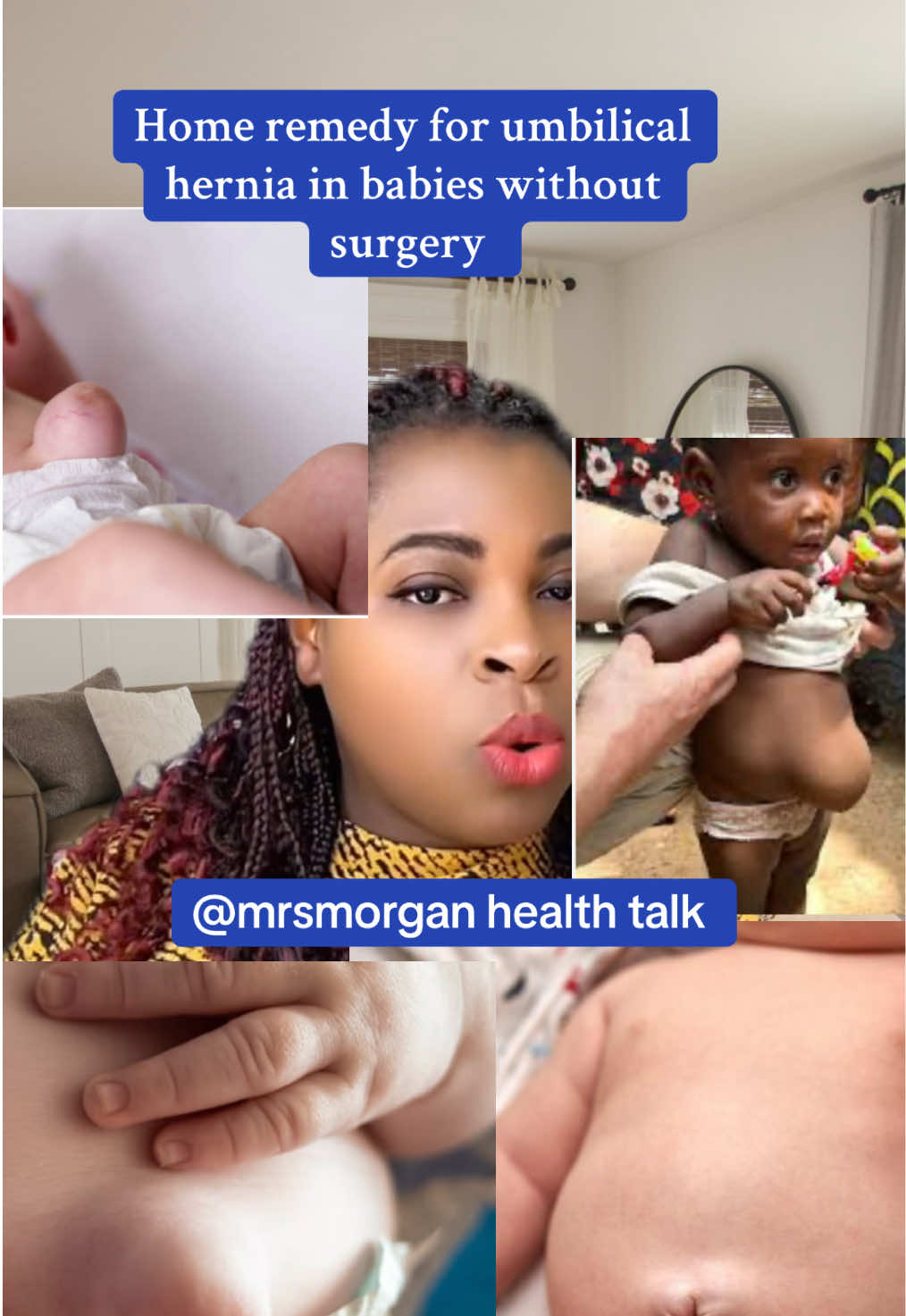Umbilical hernia in babies can resolve on it own, home remedy such as placing a wrapped coin or cotton on the hernia site and holding it in place with adhesive plaster can be of help #creatorsearchinsights #umbilicalhernia #babyhealth #newmom #parentingtips #postpartumhealth #momcommunity #homeremedy #healthcare #mrsmorganj 