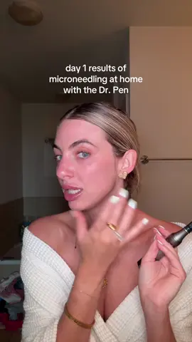 skin is inflammed but glowing from the microneedling #microneedling #microneedlingface #microneedlingtherapy #drpen 