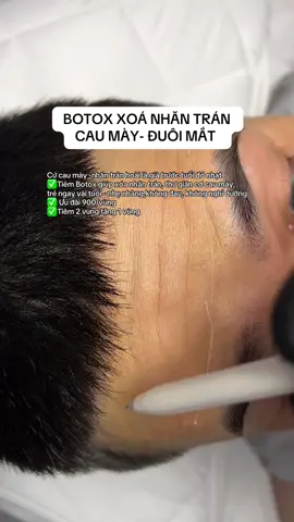 Đừng để nếp nhăn kể lại tuổi bạn. Botox xóa sạch dấu vết thời gian 👉#macademy #Mayspa #botox_xoánhăn_trán_caumày_vếtchânchim #botoxgonham #Filler_botox_uy_tín 