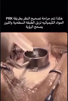جراحات تصحيح النظر تشمل PRK و LASIK، ويختلفان في التقنية ومدة الشفاء في PRK تُزال الطبقة السطحية للقرنية قبل استخدام الليزر، بينما في LASIK يُرفع جزء رقيق منها. الشفاء في PRK أطول والألم أكثر، لكنها تناسب أصحاب القرنيات الرقيقة قبل العملية، يُجرى فحص شامل للعين وينصح بالتوقف عن العدسات اللاصقة، ومراجعة التاريخ الطبي واتباع تعليمات دوائية ونفسية. بعد العملية تستخدم قطرات وينصح بالراحة وتجنّب الضوء. #الكون #سوريا #العراق ‏‎#ترند#تجميل#تيك_توك #الرياض#دبى #قطر #السعوديه #جلديه #مصر القاهرة#شفط #نحت #القوام #مشهوره#شد_الجسم