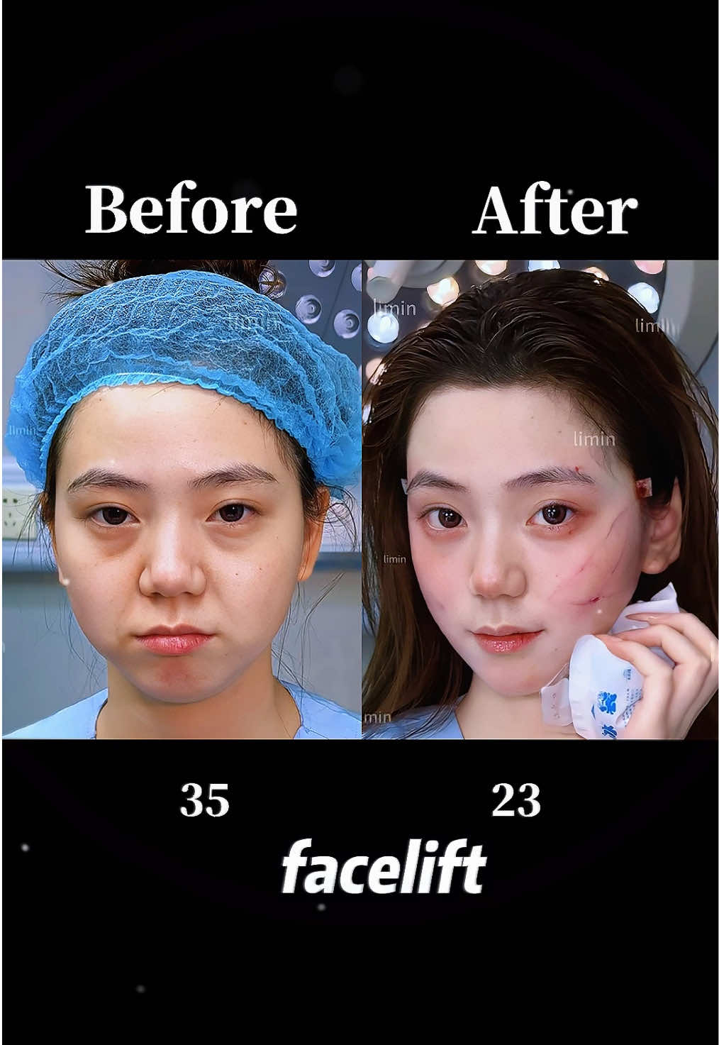 facelift #facelift #antiaging #facelifting #拉皮 #筋膜提升 