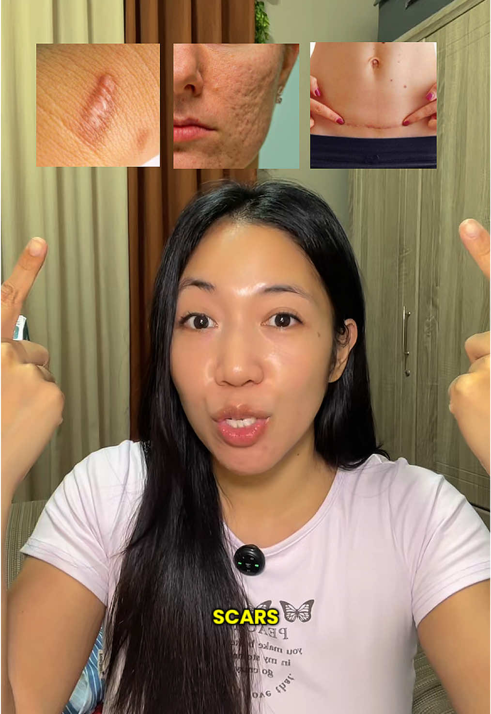 If you have keloids, acne scars, C-Section scars, wrinkles and fine lines, start usung Silicone Scar Tape! 💯  #siliconescartape #scartreatment #keloidremoval #csectionscar #acnescar 