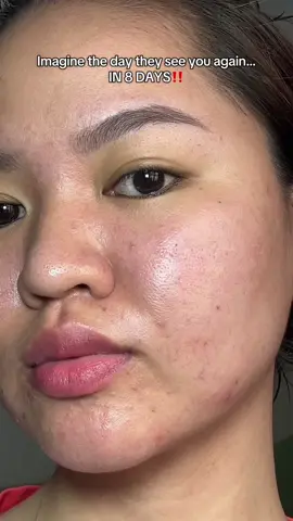 been using this serum for 8 days straight and the difference speaks for itself!🥹💖 #jmcy #jmcyph #jmcyxteashell #teashellacneserum  #foryourpage #fyp 