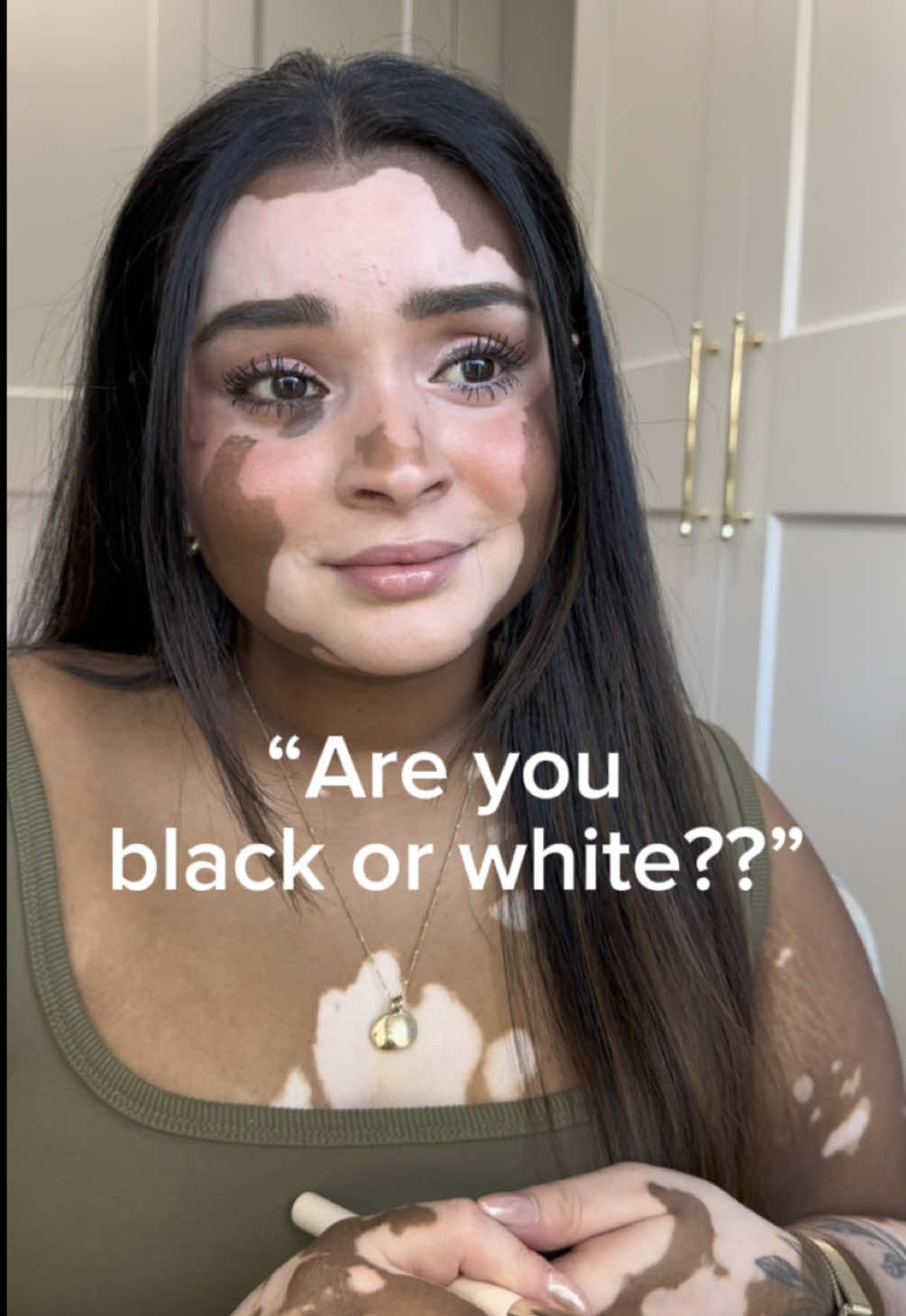 The questions I get EVERY DAY 😅 #vitiligo #trend #question #skin #srilanka 
