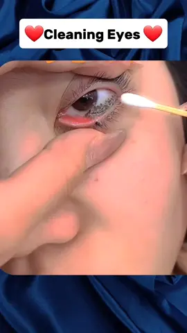 eye cleaning asmr 😌 #foryoupage❤️❤️ #asmr #treatment 
