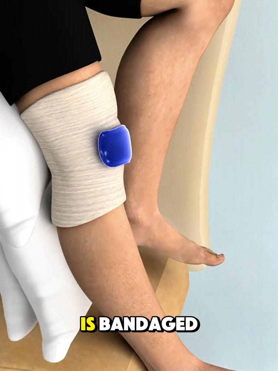 How ACL Surgery Is Performed (3D Animation) #3dmedicalanimation  #medical3danimation  #anteriorcruciateligamentreconstruction  #kneesurgery #sportsinjuryrecovery  #arthoscopy  #kneehealth 