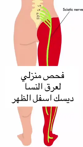 ⁨	فحص منزلي لتعرف اذا مصاب بالديسك عرق النسا  . . للحجز والاستفسار  . فرع الاردن - عمان 0792624442 🇯🇴 . فرع الامارات- دبي 043300048 🇦🇪 . فرع الامارات -الشارقة 0501040776 🇦🇪 الديسك. عرق النسا . الم اسفل الظهر . فحص سريري للديسك . علاج طبيعي في دبي . علاج طبيعي في الشارقة⁩