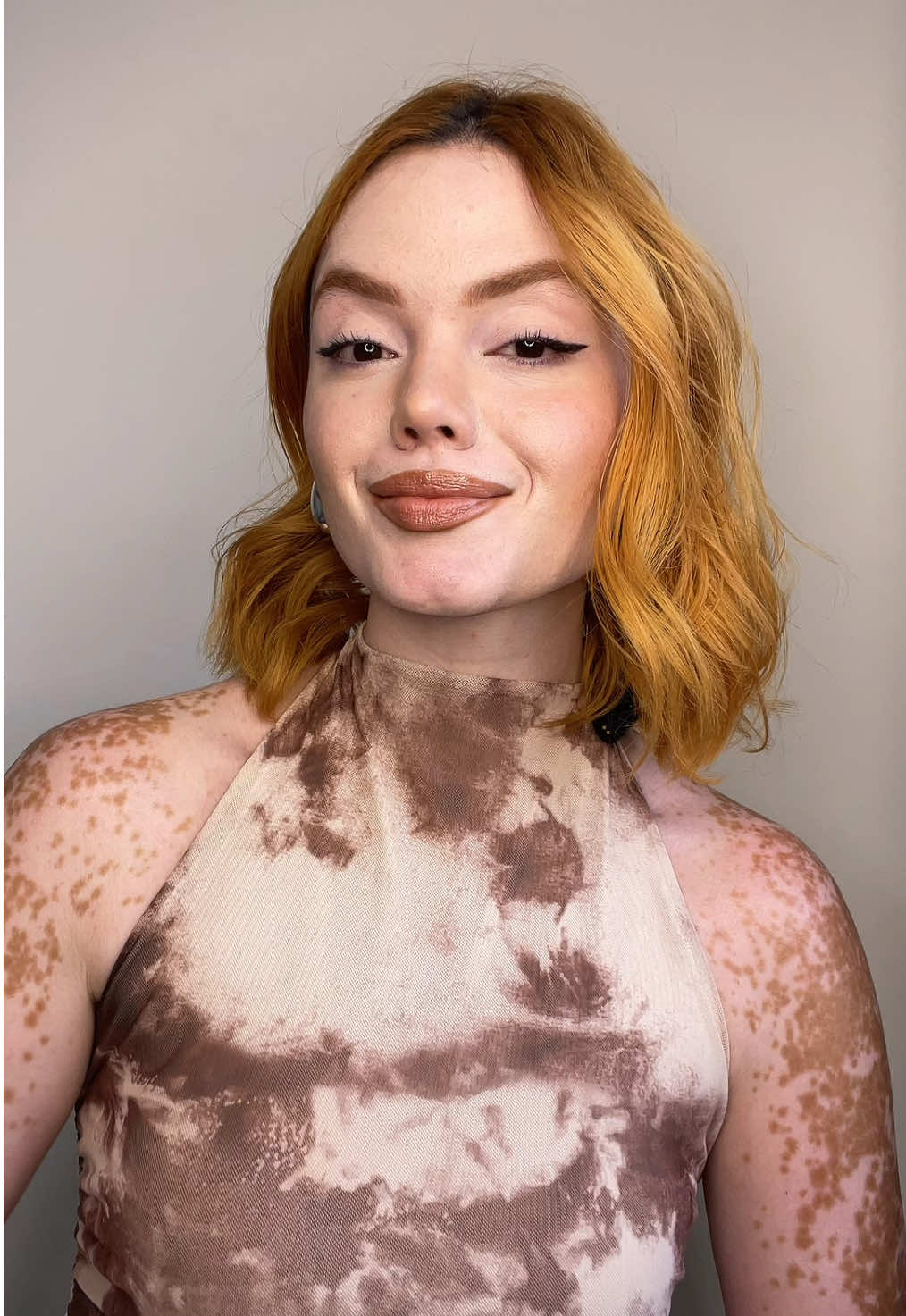 Algumas situações que já vivi por ter vitiligo. A convite da @Oncoclínicas , vim desmistificar um tema: ter vitiligo não aumenta o risco de câncer de pele! Mas o cuidado com a pele é para todos: priorizar protetor solar e hidratação sempre ajudam a manter uma pele saudável e nos previne do envelhecimento precoce e problemas futuros.  #secuida #vitiligo #bemestar #saude #cuidados #publi