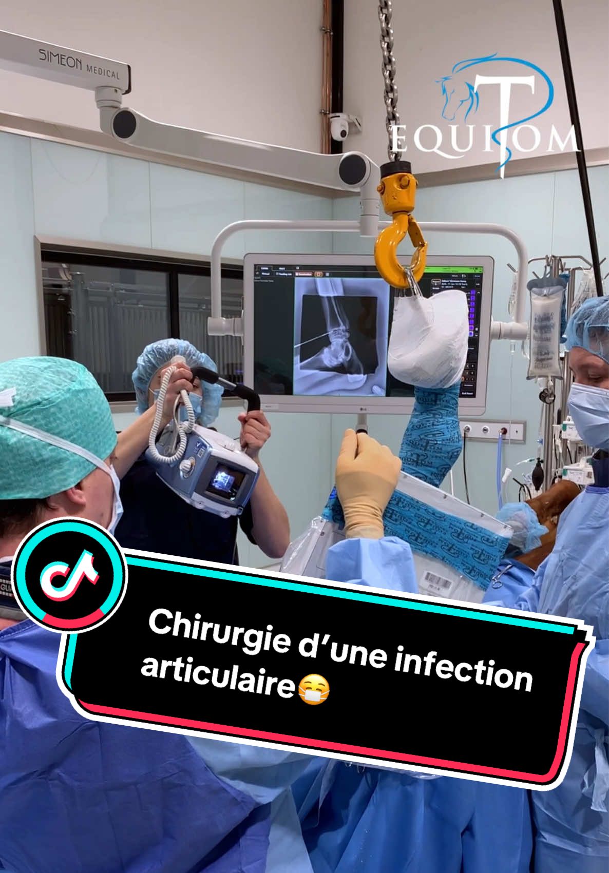🐎 Infection articulaire chronique  Ce cheval a été référé à Equitom Namur suite à une infection persistante de l’articulation tarso-métatarsienne, une petite zone du jarret particulièrement complexe à soigner lorsqu’elle est touchée durablement. Après plusieurs traitements conservateurs sans succès (injections intra-articulaires, antibiotiques par voie générale), nos vétérinaires ont opté pour une intervention chirurgicale. 😷Sous anesthésie générale, avec un guidage fluoroscopique et radiographique, l’articulation a été forée avec précision afin de prélever du tissu osseux et cartilagineux. Ces échantillons ont ensuite été envoyés en laboratoire pour des analyses bactériologiques, permettant d’identifier les bactéries responsables de l’infection. 💦L’articulation a ensuite été soigneusement lavée à l’aide d’antiseptiques dilués injectés via des aiguilles positionnées à différents endroits. Plusieurs trous de forage ont été réalisés : ils permettent à la fois de détruire l’articulation atteinte, mais aussi de créer des canaux dans lesquels a été inséré du plâtre de Paris, un matériau résorbable à effet ostéo-inducteur. Ce plâtre est chargé d’antibiotiques, assurant un relargage local intensif pour traiter l’infection. Une procédure technique et pointue… mais plus que nécessaire pour permettre à ce cheval de retrouver de la mobilité et du confort💙  #EquitomNamur #chirurgievétérinaire #cliniquevétérinaire 