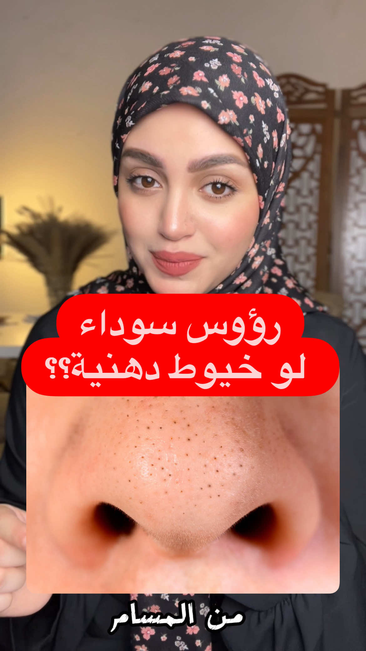 شلون نعالج الخيوط الدهنية ؟؟  #سالسليك_اسيد #رؤوس_سوداء #خيوط_دهنية #غسول_زيتي 